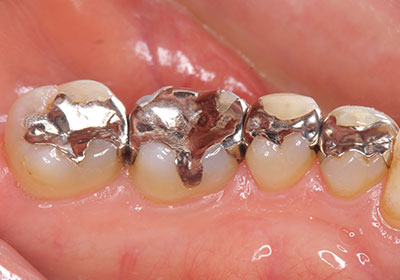 銀歯は全身の健康を脅かし、虫歯再発リスクのある素材です