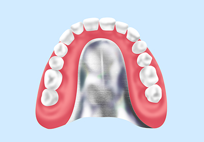 金属床義歯