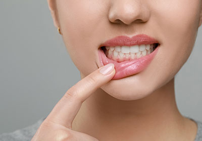 歯周病は歯ぐきの腫れや骨が溶かされる病気です